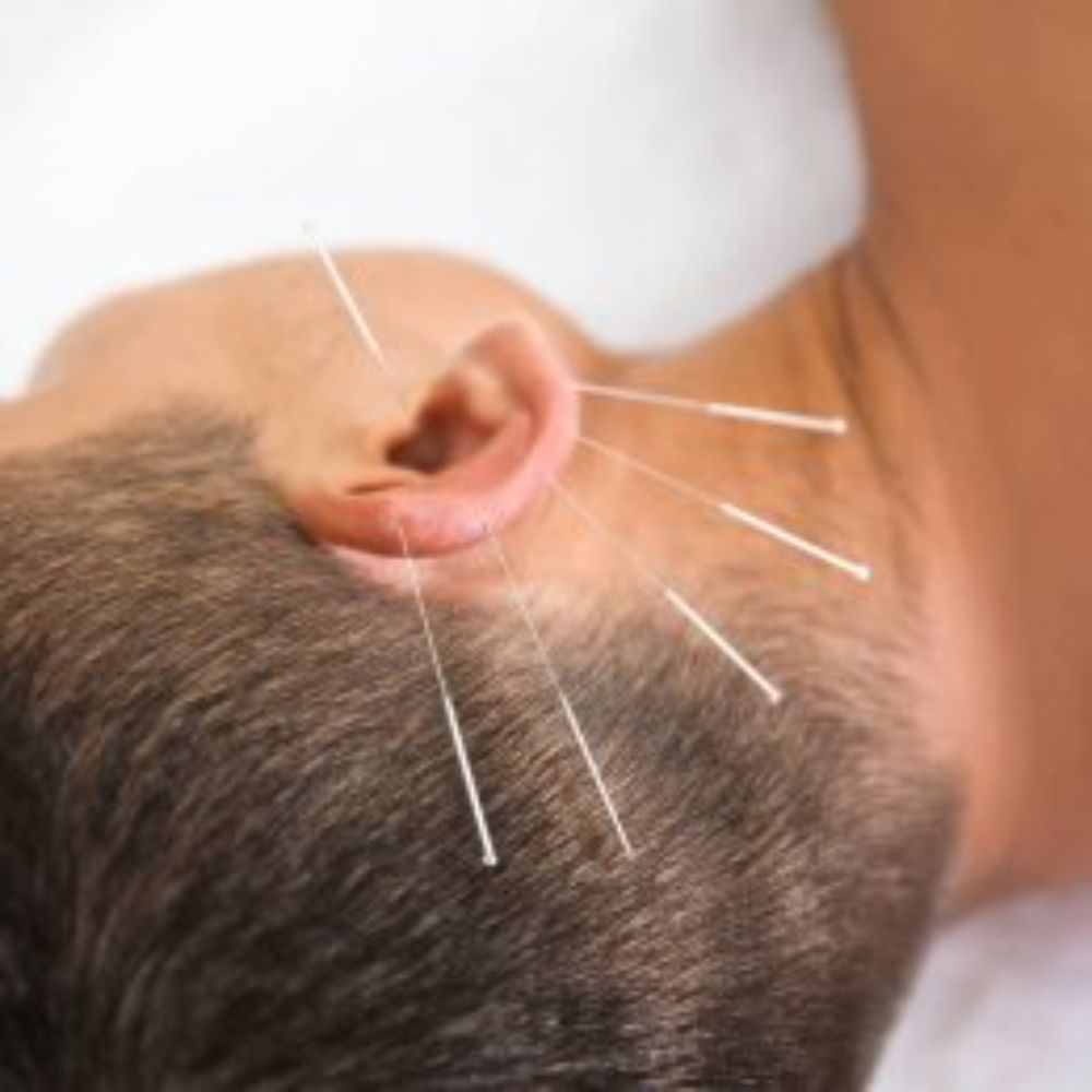 Professional Acupuncture Therapy in Shelton, CT