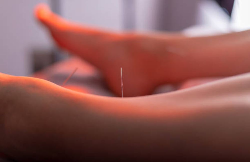 Professional Acupuncture Therapy in Shelton, CT